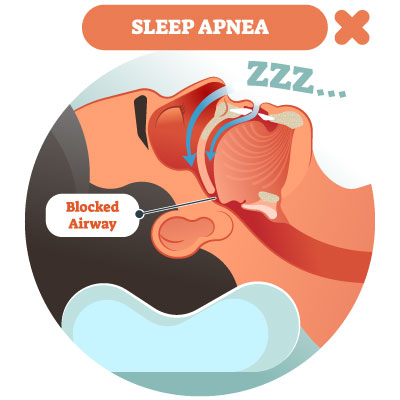 obstructed breathing during sleep